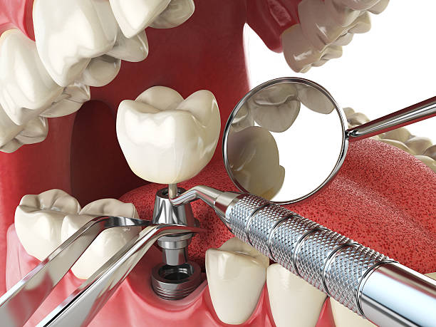 Best Chipped Tooth Repair Near Me  in USA